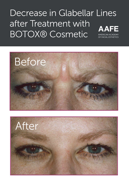 BA-Botox