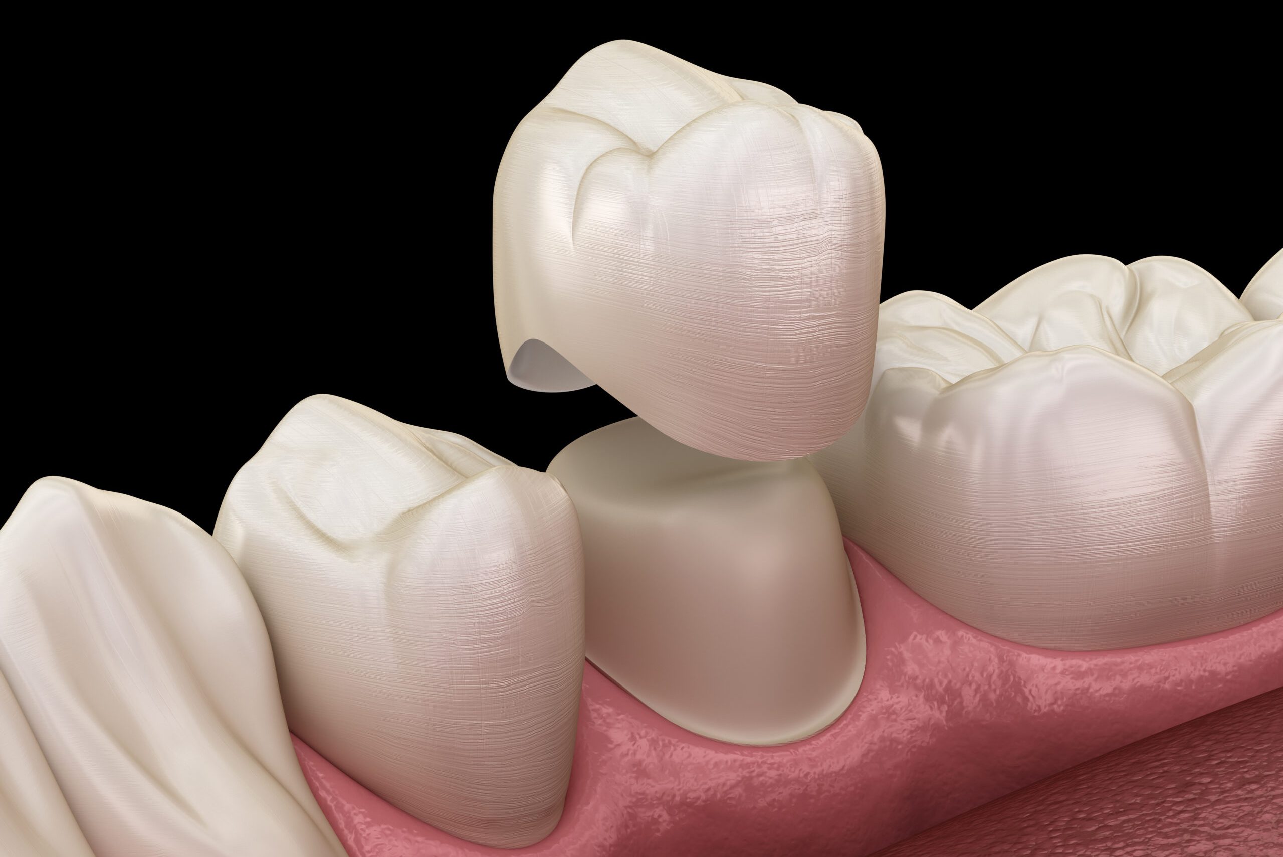 Dental crown premolar tooth assembly process. Medically accurate 3D illustration of human teeth treatment